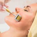 Cây lăn kim chuyên dụng hỗ trợ tái tạo da, cải thiện sẹo J145
