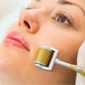 Cây lăn kim chuyên dụng hỗ trợ tái tạo da, cải thiện sẹo J145