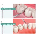 Bộ 3 dụng cụ lấy cao răng cao cấp vệ sinh răng tại nhà tiện lợi BA912